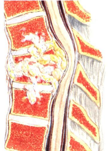 TBC spondylitis 1/2 všech případů Th a L páteř- malum Potti C páteř - malum Rusti Osteolytické ložisko v přední části těla Postižení 2-3 obratlových