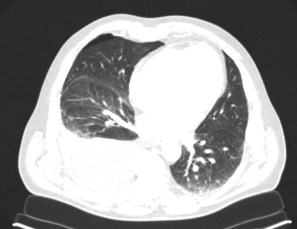 Kazuistika, muž, 67let kontrolní HRCT (za 4 měsíce) progrese fluidotoraxu