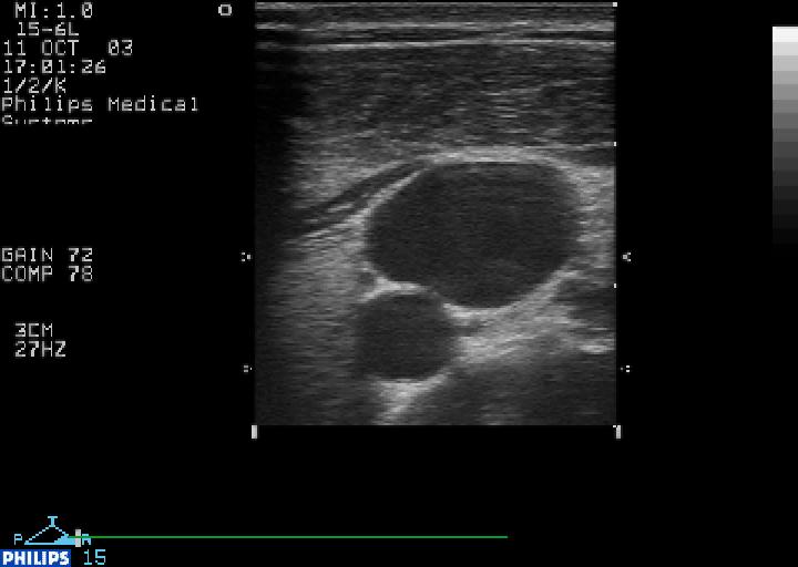 Centrálních žilní kanylace (a kardiostimulace) pod kontrolou UZ Meta-analysis: Hind et al BMJ 2003 U/S guided IJV, dialysis: Nephron 1998 NICE: Guidance on the use of ultrasound locating devices for