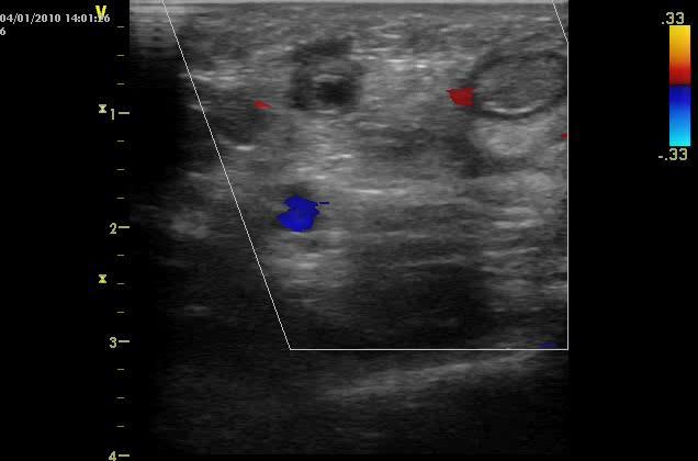 Vyšetření žilního systému Lumen žíly a jeho kolapsibilita při přímém tlaku sondou Trombus: lumen nekolabuje Duplexní sonografie : CD+PW Odečet po