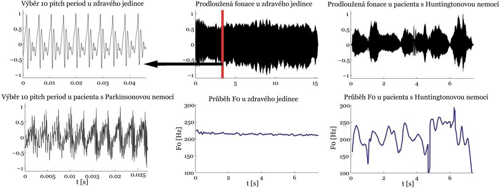 Fonace: efekt poruchy bazálních ganglií Hypokineze Normální hlas Hyperkineze Jitter = 0,3%