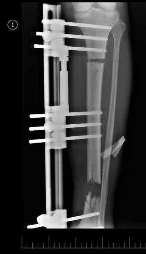 390/ Acta Chir Orthop Traumatol Cech. 83, 2016, No. 6 PŮVODNÍ PRÁCE Obr. 1. Rtg snímek otevřené zlomeniny bérce v předozadní projekci. Obr. 3. Rtg snímek po osteotomii a začátku kalusdistrakce. Obr. 4.