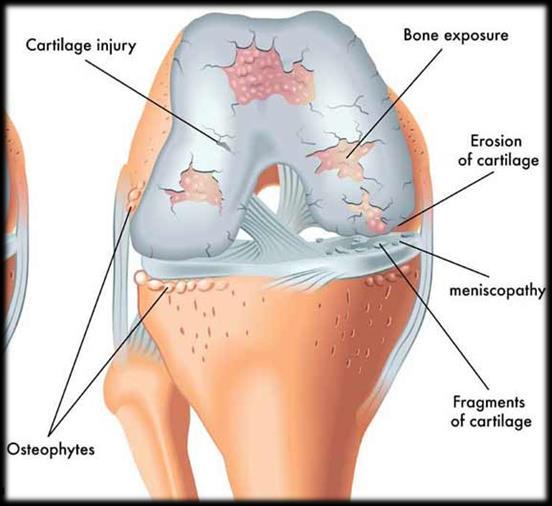 ÚVOD DO PROBLEMATIKY Osteoartróza Viskosuplementace Rozvláknění struktury, odhalení subchondrální