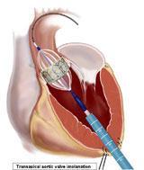 TAVI Transcatheter Aortic