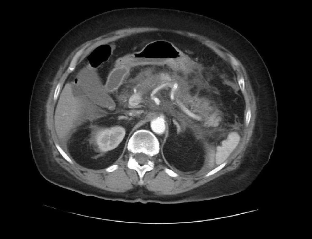 Obrázek 2 - CT vyšetření ze dne 1. 6. 2016 Zdroj - WinMedicalc Výpočet CTSI: stádium E (4 body) + nekróza nad 50 % žlázy = 10 bodů. Výsledek 10 bodů značí těžkou akutní pankreatitidu. Den 7, 6. 6. 2016: USG vyšetření břicha.