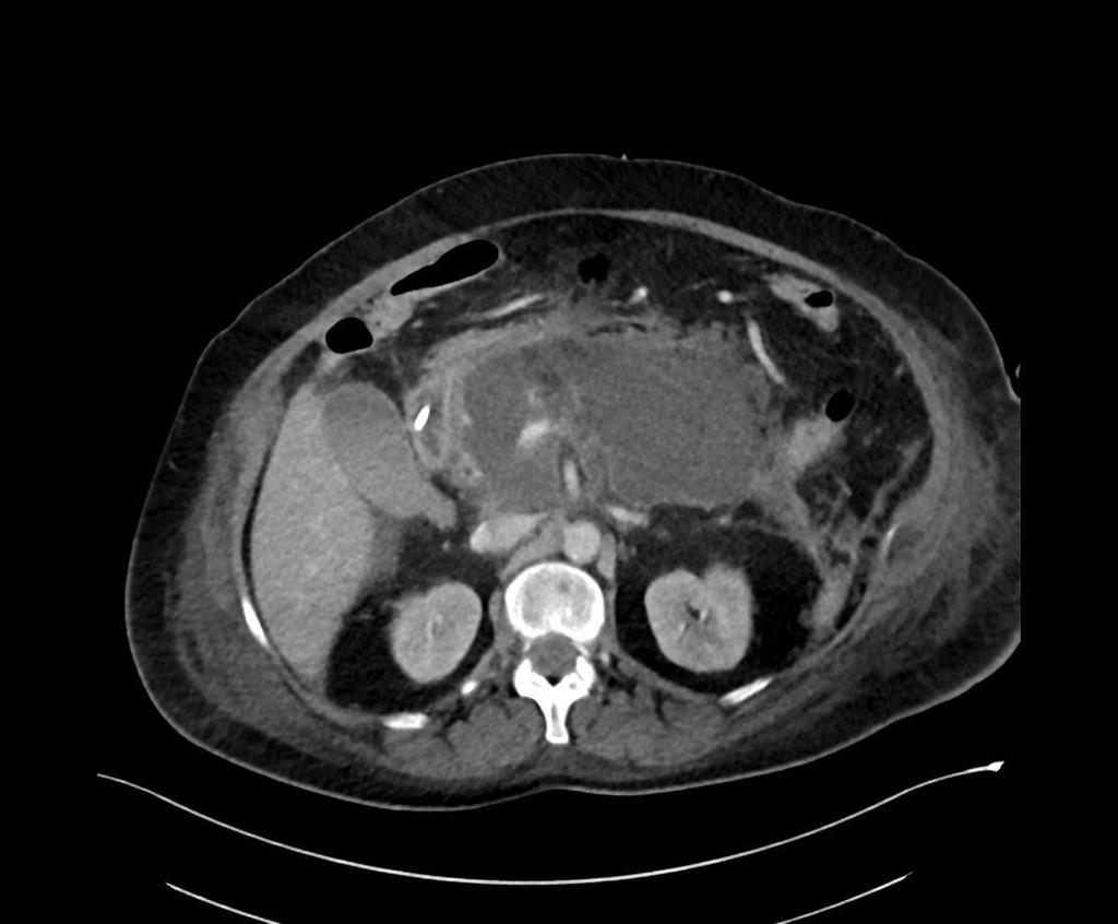 Obrázek 4 - CT vyšetření ze dne 16. 6. 2016 Zdroj - WinMedicalc Výpočet CTSI: stádium E (4 body) + nekróza nad 50 % žlázy = 10 bodů. Výsledek 10 bodů značí těžkou akutní pankreatitidu. Den 35, 4. 7.