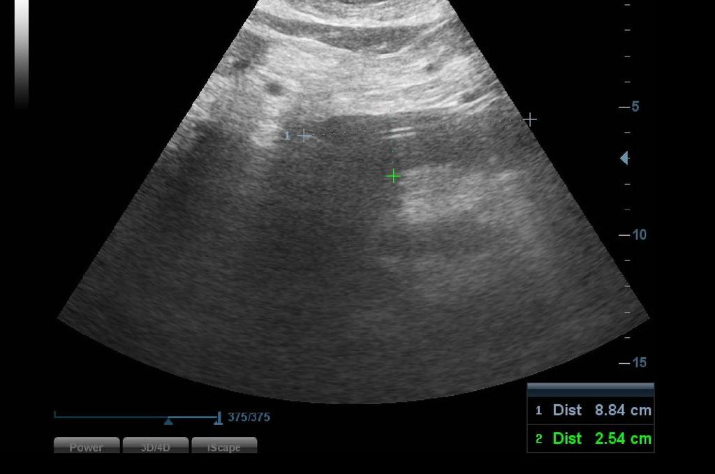 Obrázek 7 - USG vyšetření ze dne 17. 7. 2016 Zdroj - WinMedicalc Den 51, 20. 7. 2016: CT vyšetření břicha, po podání KL i. v. Nekrotizující pankreatitis ve stadiu pseudocyst, které postihují celý pankreas, jsou patrné jen drobné residuální okrsky pankreatické tkáně.