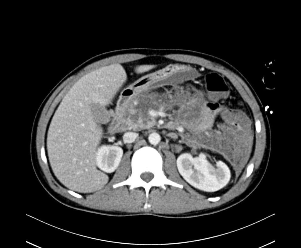 Obrázek 12 - CT vyšetření ze dne 9. 12. 2015 Zdroj - WinMedicalc Výpočet CTSI: stádium E (4 body) + nekróza nad 50 % žlázy (6 bodů) = 10 bodů. Nález odpovídá těžké akutní pankreatitidě. Den 19, 18.