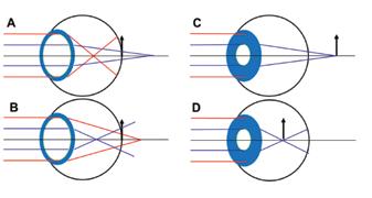 Obr. 1: Emetropické oči s 6 mm zornicí a pozitivní (A), negativní (B) sférickou aberací. Periferní paprsky se více lámou jak paraxiální. Stejné oči po akomodativní mióze (C a D).