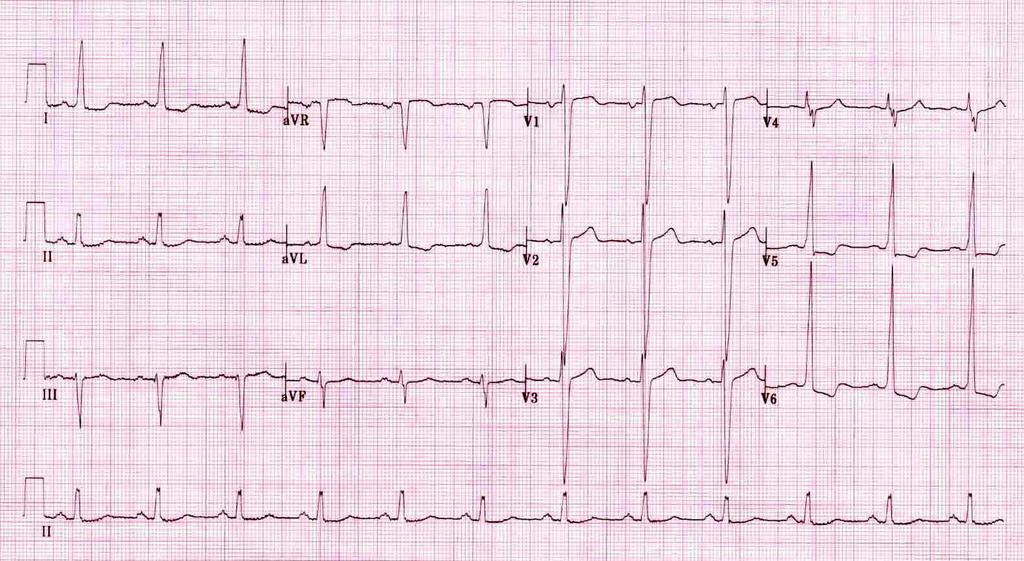 EKG Známky hypertrofie a zatížení LK AV blokády