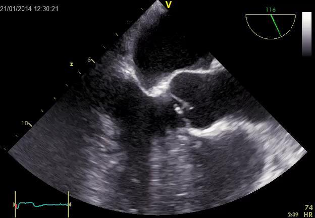 kořene aorty Aortoanulární ektázie Marfanův sy Bikuspidální chlopeň