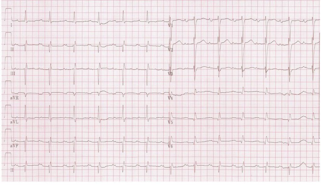 EKG sinusový rytmus 74/min, PQ 0,24, QRS 0,10, semihorizontální osa, AVB I.st.