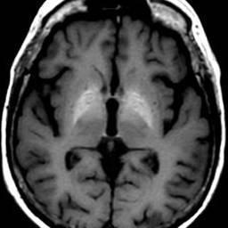 MR a neurologické symptomy MR provedeno u pacientů s nejvyššími hodnotami (cholestázou)