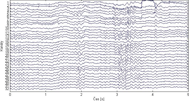 3.3 EEG vlny Jednotlivé vlny, které tvoří EEG signál, mají různý frekvenční obsah (tedy spadají do určitého frekvenčního pásma). Intervaly frekvenčních pásem se však u různých autorů odlišují.