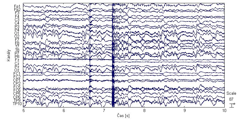 Analysis) reziduálních artefaktů a výběru dominantních komponent. Takto získaný vzor je poté odečten od každé epochy signálu. Na obr. 4.2 je ukázka EEG záznamu shodného se záznamem na obr. 4.1 s potlačenými gradientními artefakty pomocí tohoto nástroje.