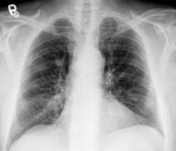 Stádium IV je prognosticky nejhorším stádiem, plicní fibróza, tedy zjizvení plicní tkáně,
