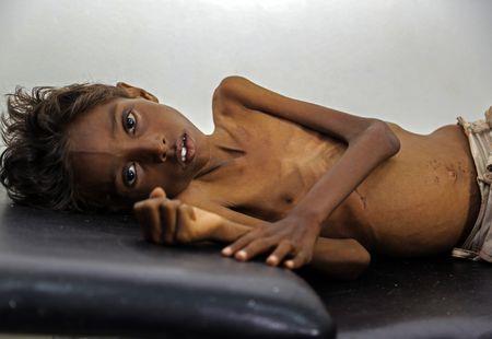 Pětiletý Tarik strádající těžkou podvýživou leží v nemocnici ve městě Abs v provincii Hajjah.