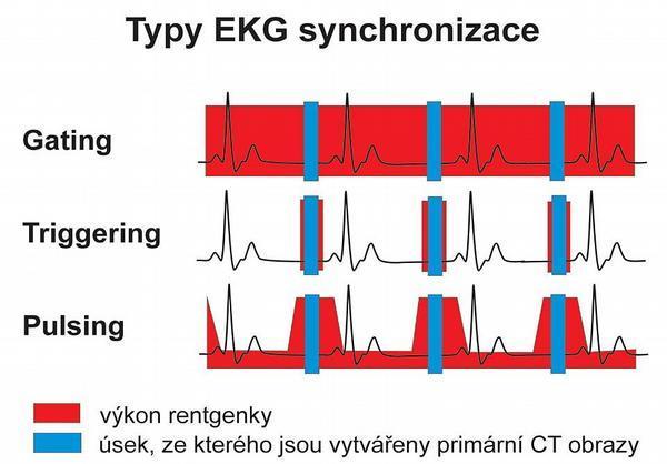 Interval R-R Pro synchronizaci je třeba přesného určení jednoho srdečního cyklu. Ve většině případů se jako počátek a konec jednoho cyklu zvolí kmit R.