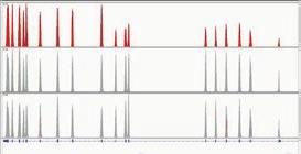 abnormality glykosylace se mohou objevovat i u poruch CDG. 4. 7.(gen NOTCH3 9.