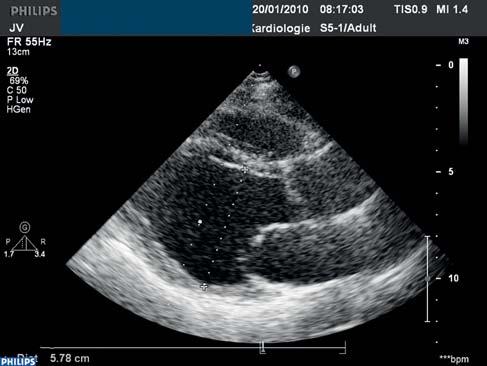 Obrázek 2 Echokardiografie; hraniční dilatace (58 mm) a systolická dysfunkce levé srdeční komory (ejekční frakce 34 %) Při svalové biopsii z m. vastus lateralis dex.