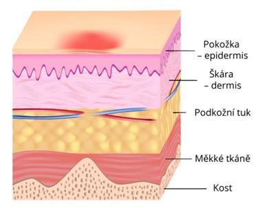 Mezinárodní NPUAP/EPUAP systém klasifikace dekubitů Klasifikuje dekubitus podle stupně závažnosti postižení do 4 základních stupňů, ale v rámci NPUAP jsou tyto stupně rozšířeny na kategorii