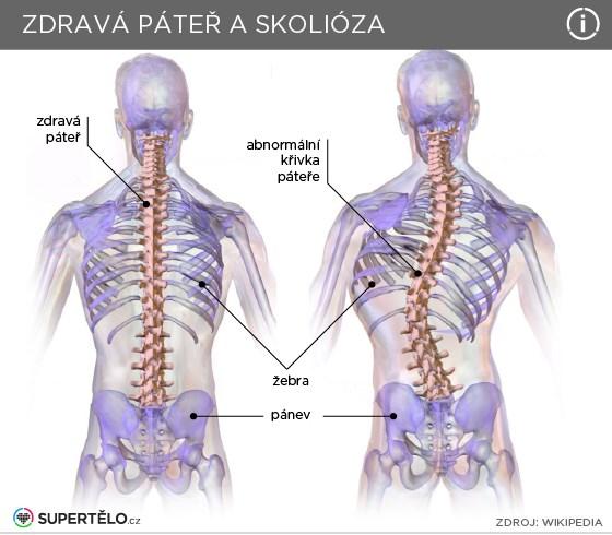 Odchylky od správného držení těla předsun hlavy 26 % dětí (častěji u chlapců) kulatá záda / zvýšená hrudní kyfóza - 14 % (častěji u chlapců) skoliotické držení - 13 % (bez rozdílu mezi chlapci a