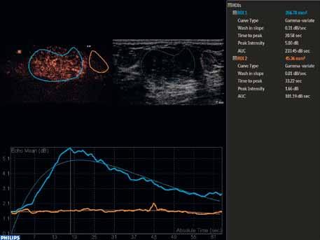 Obr. 5 Obr. 5. Kvantitativní analýza CEUS. Záznam změn prokrvení ložiska v čase pomocí vykreslené křivky intenzit u histologicky verifikovaného benigního ložiska prsu fibroadenomu.