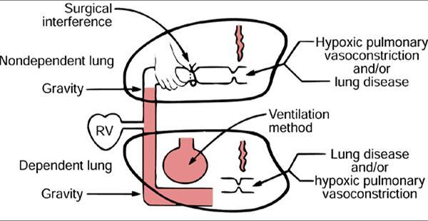 Ovlivnění oxygenace Hypoxická plicní vasokonstrikce. Ventilační režim. Efektivita PEEPu. Gravitace.