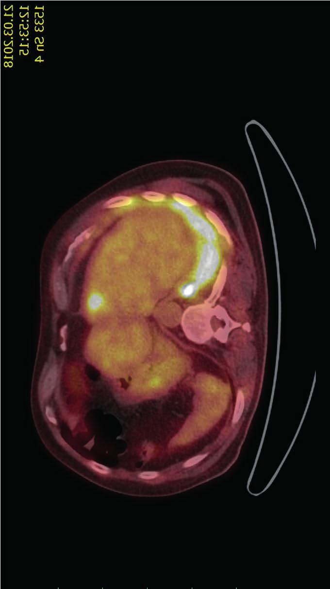 KAZUISTIKY PACIENTŮ LÉČENÝCH OSIMERTINIBEM Obr. 4: PET/CT v březnu 2018 progrese gresi, byla indikována paliativní radioterapie na ložisko dle PET/CT v levém femuru a raménku kosti stydké vlevo od 7.