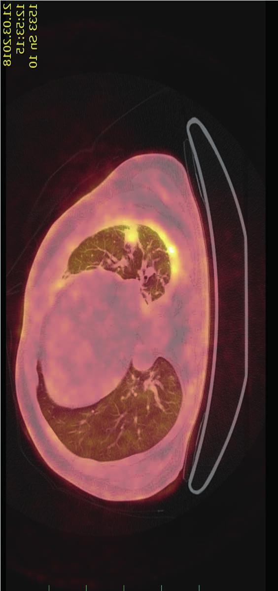 Na PET/CT v březnu 2018 však byl nově popsán hypermetabolismus glukózy v ložis - ku v jaterním parenchymu svědčící s největší pravděpodobností pro generalizaci neoplázie, zvýšila se také konsumpce