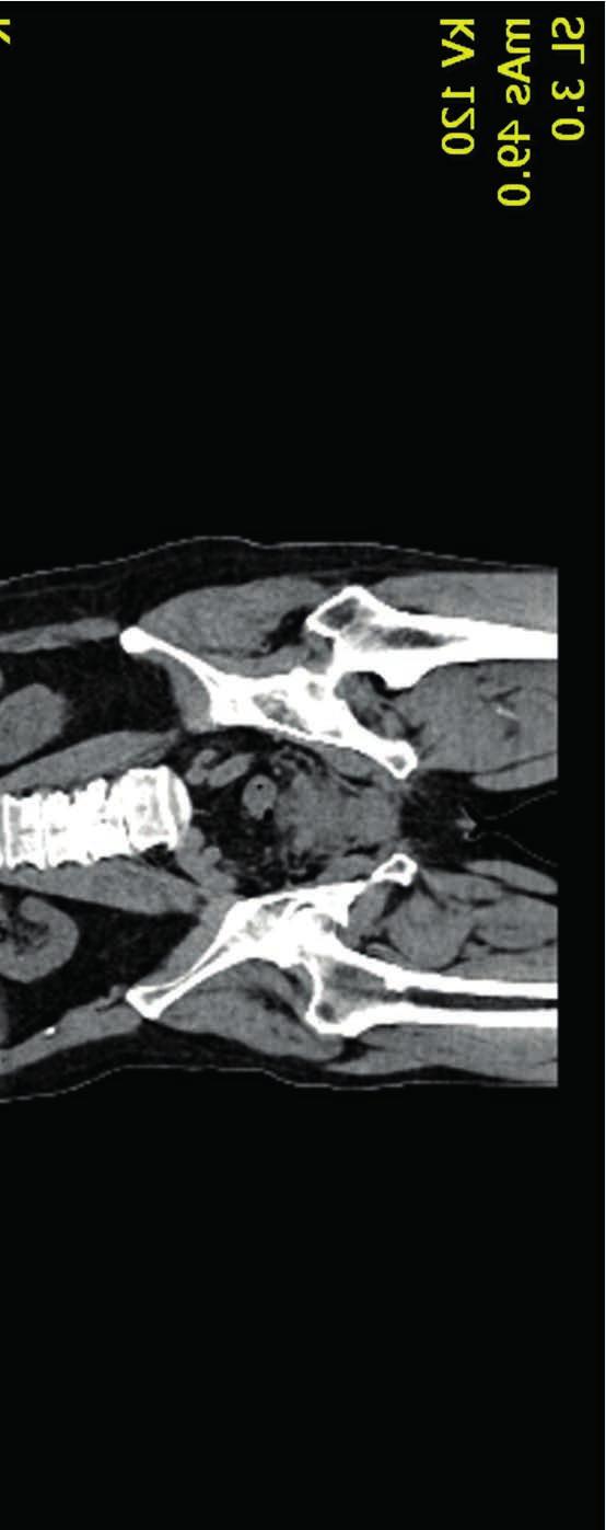 Minule popisovaná ložiska ve skeletu byla již sklerotická a bez patologické konsumpce glukózy neviabilní neoplázie (obr. 4). Léčba afatinibem (GIOTRIF) byla proto 22. března 2018 ukončena.