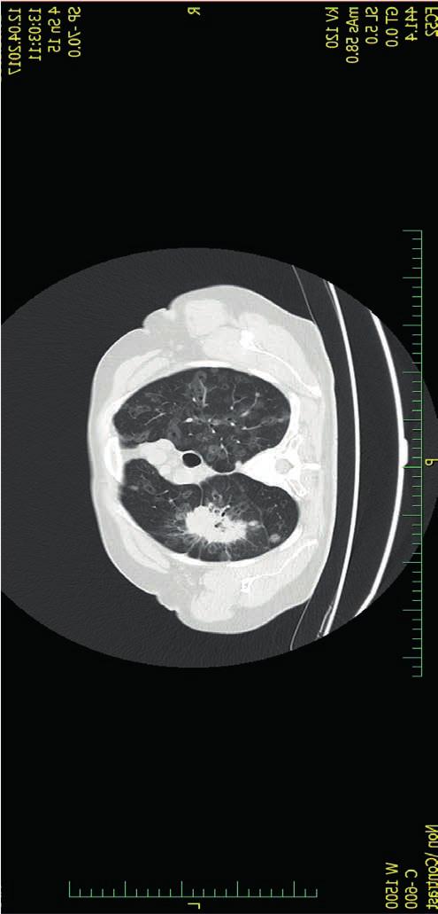 5: PET/CT v říjnu 2018 bez viabilní neoplázie Zdroj obrázku: Nemocnice Na Homolce, Praha mutace T790M v exonu 20 genu EGFR. Byla proto 3. dubna 2018 zahájena léčba osimertinibem (TAGRISSO).