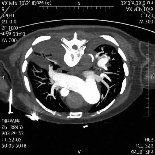 RYCHLÁ PROGRESE PLICNÍ HYPERTENZE Obr. 5: CT angiografie, únor 2018 v rámci plicní hypertenze (obr. 5).
