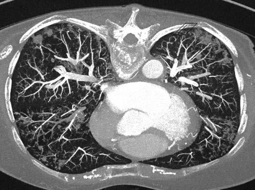 Intrabronchiální nález byl normální, uvedené odběry na bakteriologii byly negativní. Léze nebyly dosažitelné biopsií pod CT kontrolou, proto byla navržena verifikace procesu chirurgickou cestou.