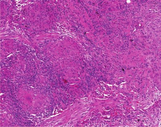 Makroskopicky nalezl operatér drobná krémová ložiska a materiál odeslal na histopatologické vyšetření a na mikrobiologické pracoviště TBC diagnostiky.