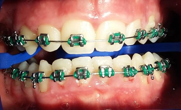 Obrázek 3 Zánět dásní 7.2 Chemické prostředky orální hygieny ke snížení vzniku rizika Svými účinky zamezují tvorbě plaku, zvyšují odolnost tvrdých zubních tkání.