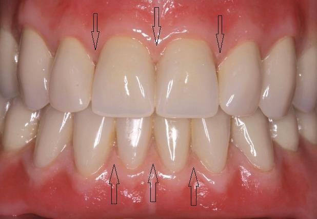 Podílí se na tvorbě gingivodentálního spojení, je široká přibližně 0,8 2,5 mm, má hladký povrch a zhruba u 40% dospělých můžeme, na volné gingivě, nalézt dolíčkovaný povrch (stippling). 3.1.