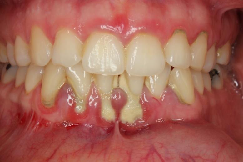 5 Zubní kámen (calculus dentium) Zubní kámen se řadí mezi zubní povlaky.