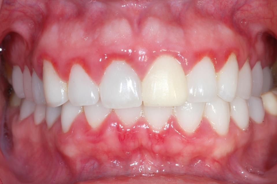 6 Zánět dásní - gingivitis Gingivitida je nejčastějším onemocněním dásní.