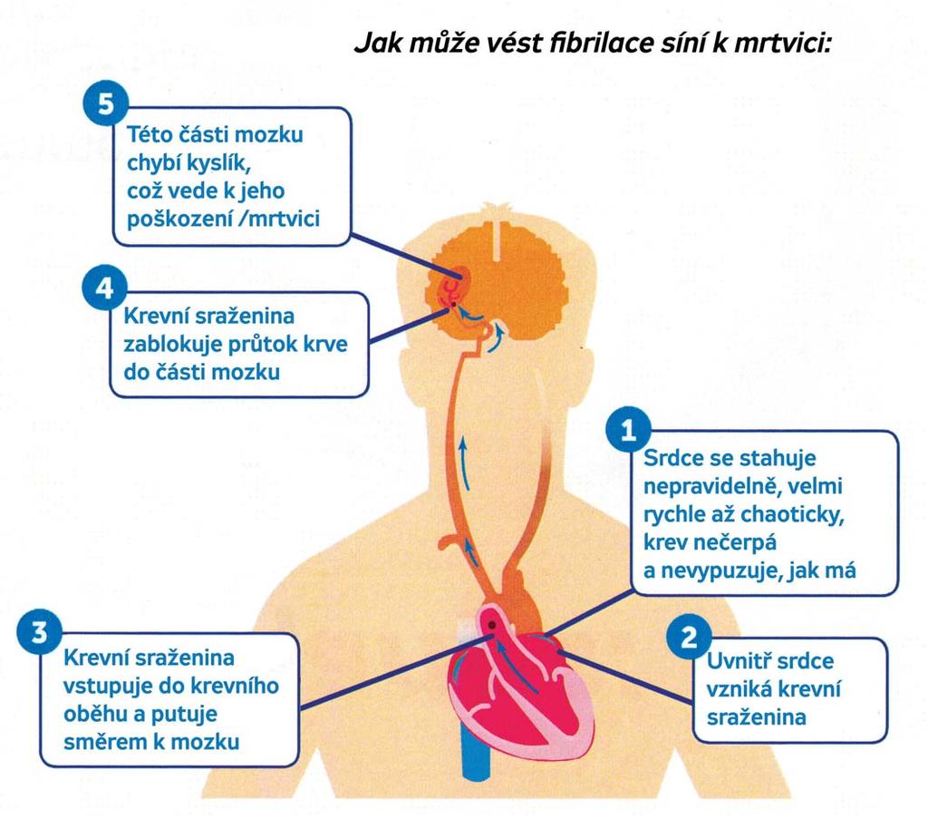 3 2. Fibrilace síní jako rizikový faktor cévní mozkové příhody (CMP) či Transitorní ischemické ataky (TIA) Fibrilace síní je příčinou nepravidelného srdečního rytmu, jakéhosi ševelení srdečních síní,