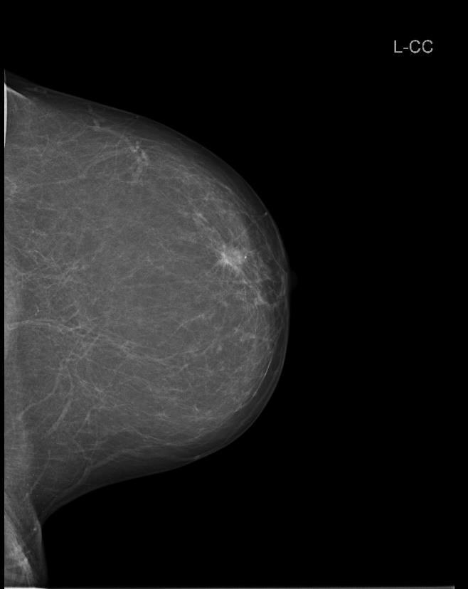 Obr. 12 - Mamografický snímek levého prsu craniokaudální Obr.