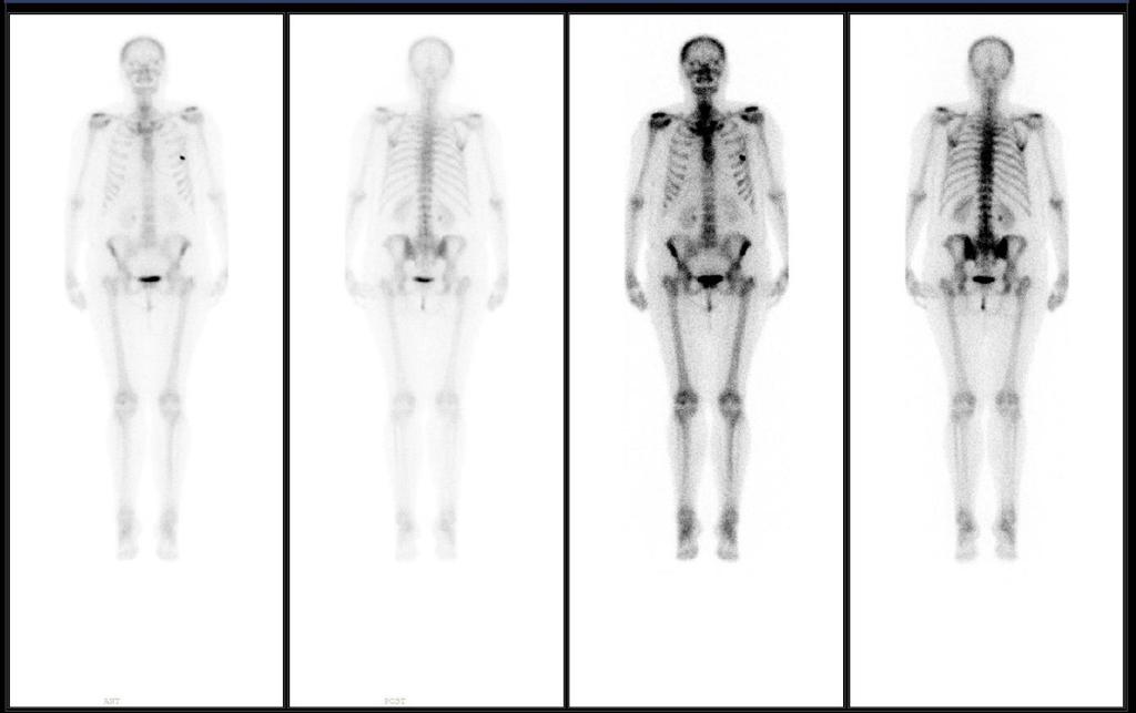 Obr. 14 - Scintigrafie