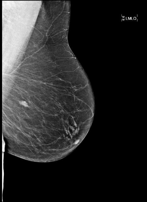 Histologie sentinelové uzliny Lymfatickou uzlinou 8x4x3 mm byla rozpůlena a zpracována celá, prokrájena v sérii řezů včetně imunohistochemického vyšetření.