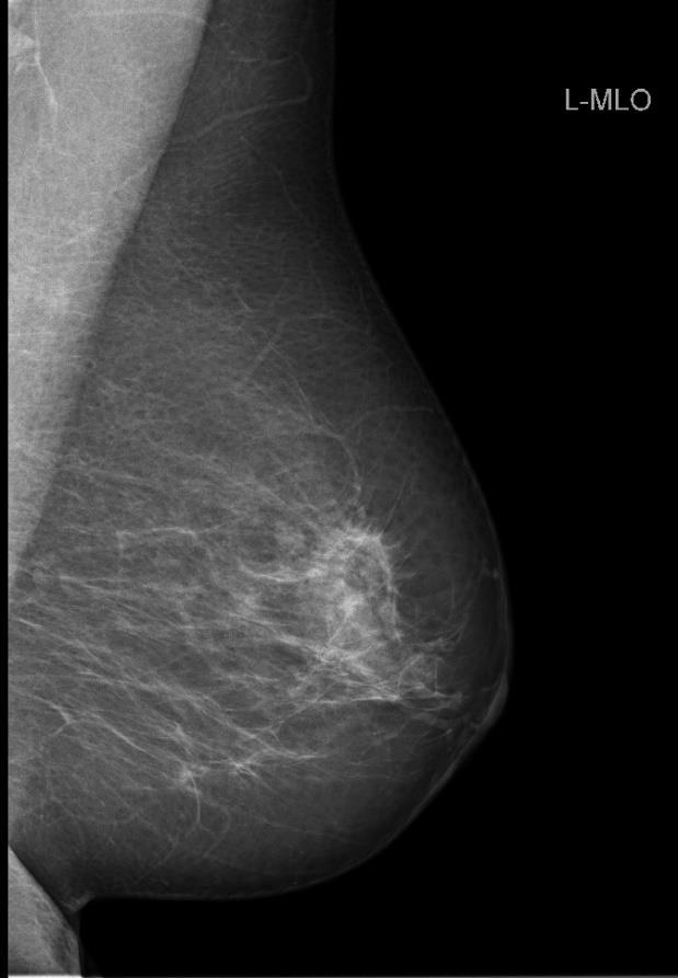 Obr. 18 - Mamografický snímek levého prsu craniocaudální Obr.