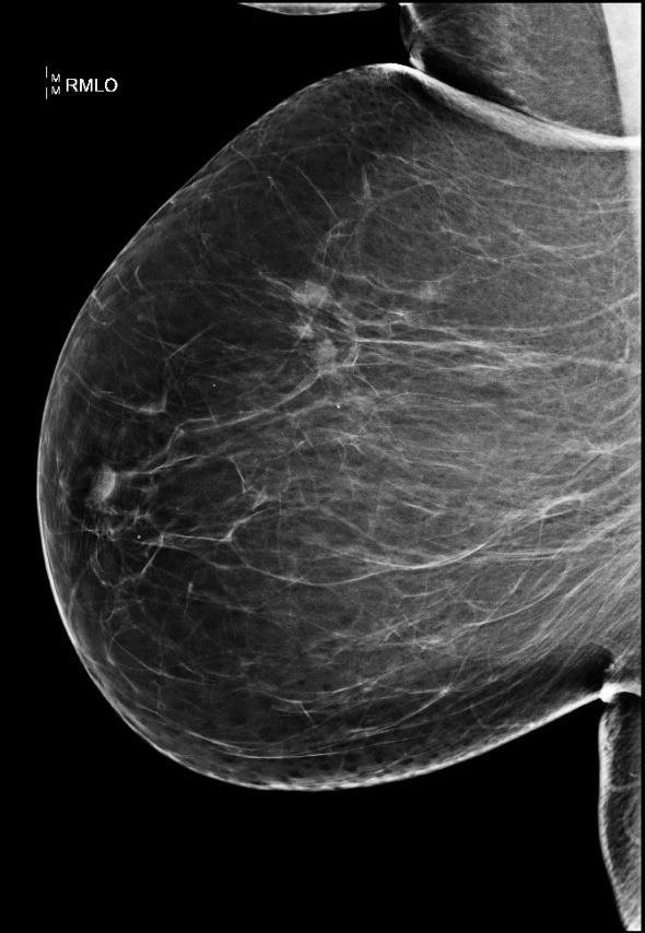 22 - Mamografický snímek pravého prsu mediolaterální