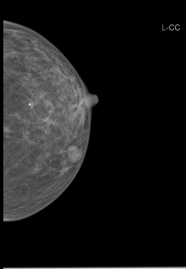 Obr. 29 - Mamografický snímek levého prsu craniocaudální Obr.