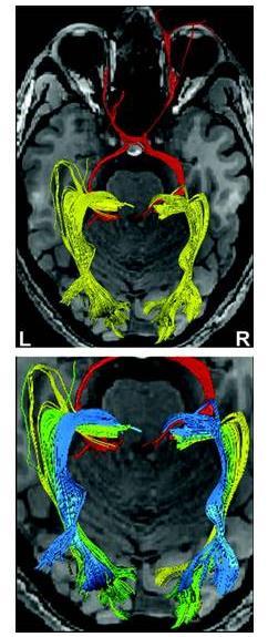 1/2 zorného pole) fasciculus centralis fasciculus posterior = horní (Baumova)