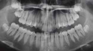 9 1.5 Maxillary Dentition U1 NA (mm) U1 SN ( ) 4.0 103.0 2.8 98.0 3.2 103.7 Mandibular Dentition L1 NB (mm) L1 GoGn ( ) 4.0 93.0 2.1 95.6 3.9 102.