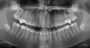 X-ray after Forsus Appliance. 11 Obr. č.