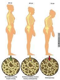 Pohybový systém Změny na kostech, svalech a kloubních strukturách Každý týden se ztrácí cca 20 % svalové síly Osteoporóza